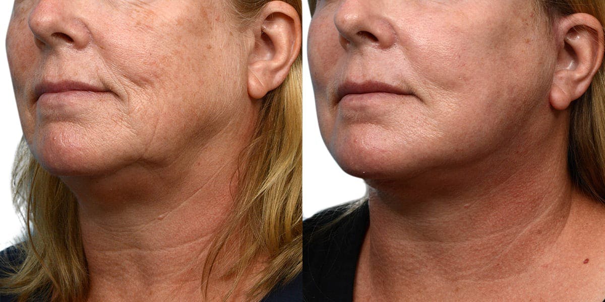 Facelift Before & After Gallery - Patient 205840 - Image 2