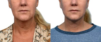Facelift Before & After Gallery - Patient 210287 - Image 1