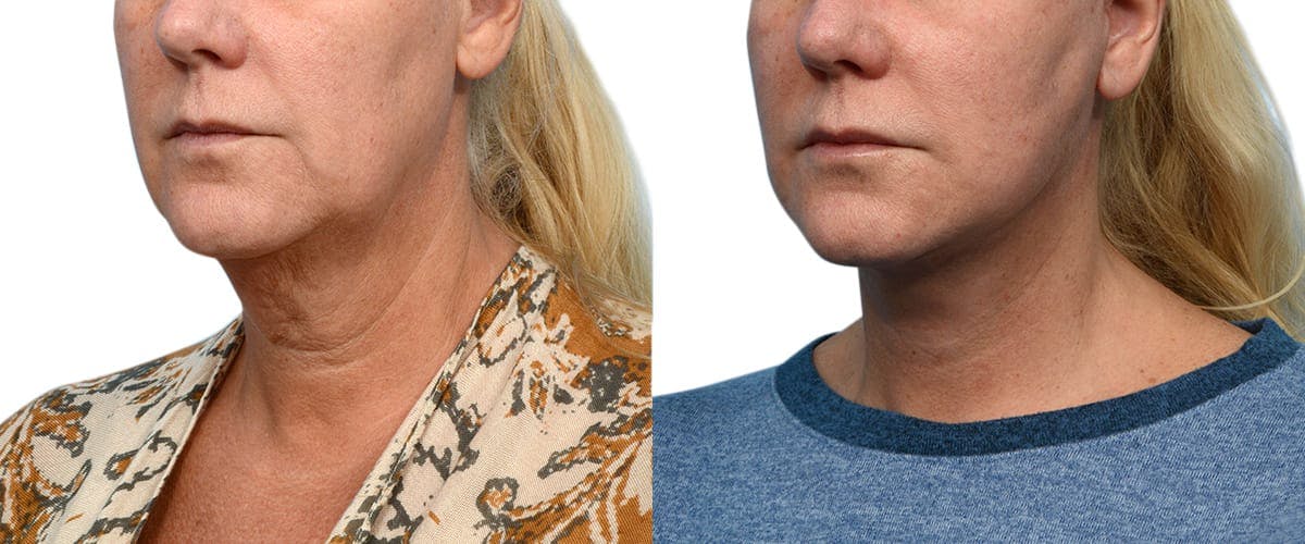 Facelift Before & After Gallery - Patient 210287 - Image 2