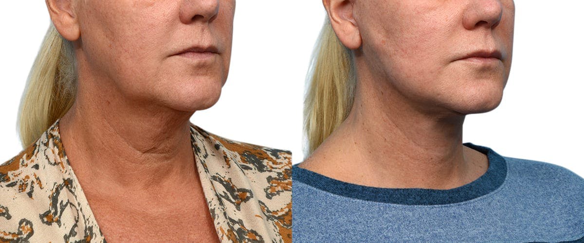 Facelift Before & After Gallery - Patient 210287 - Image 3