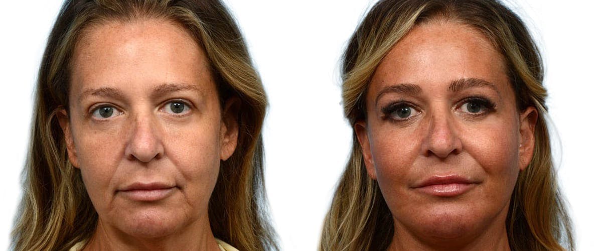 Facelift Before & After Gallery - Patient 270565 - Image 1