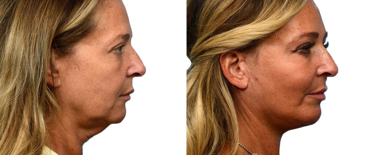 Facelift Before & After Gallery - Patient 270565 - Image 2