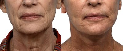 Facelift Before & After Gallery - Patient 258513 - Image 1
