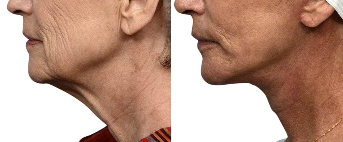 Facelift Before & After Gallery - Patient 258513 - Image 2