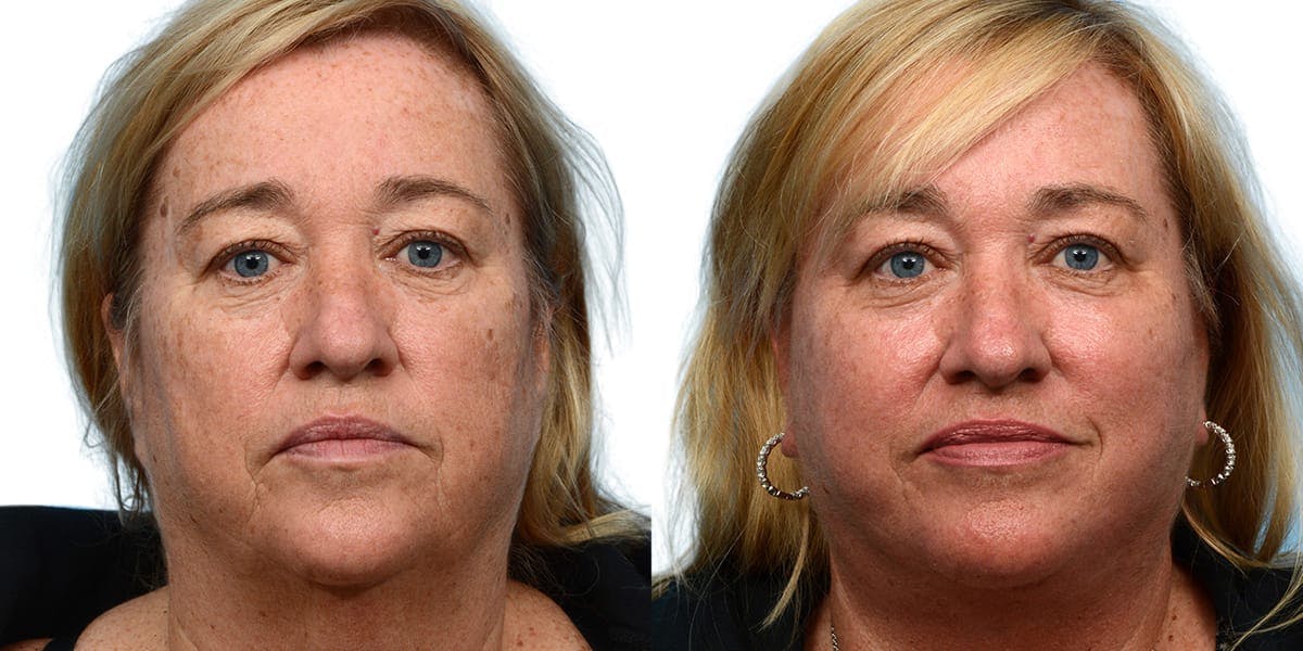 Facelift Before & After Gallery - Patient 779916 - Image 1