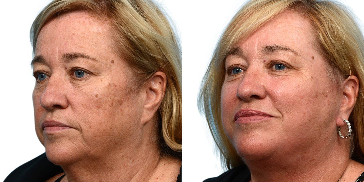 Facelift Before & After Gallery - Patient 779916 - Image 2