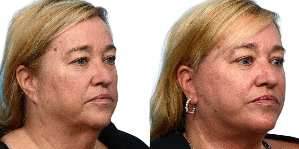 Facelift Before & After Gallery - Patient 779916 - Image 3