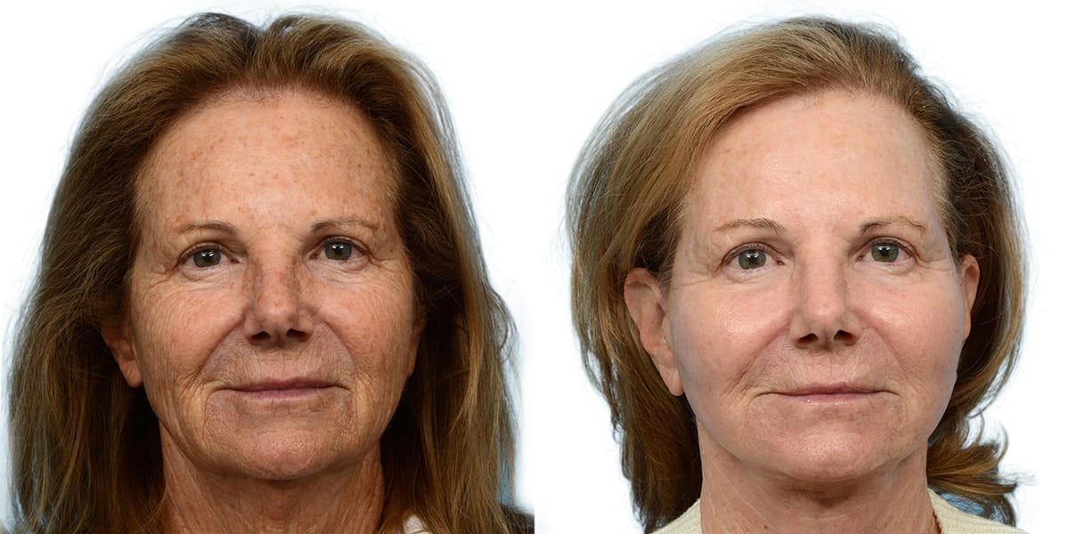 Patient 483037 | Facelift Before & After Photos | Dr. Wise