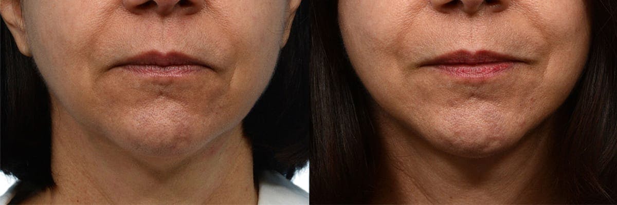 Facelift Before & After Gallery - Patient 101438 - Image 1