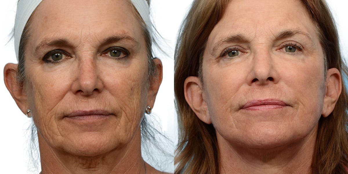 Facelift Before & After Gallery - Patient 319106 - Image 1