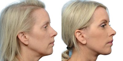 Facelift Before & After Gallery - Patient 373752 - Image 1