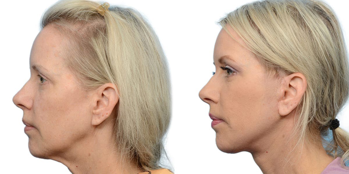 Facelift Before & After Gallery - Patient 373752 - Image 2