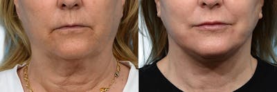 Facelift Before & After Gallery - Patient 143867 - Image 1