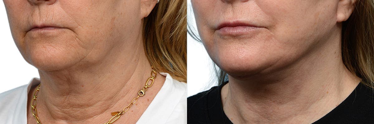 Facelift Before & After Gallery - Patient 143867 - Image 3