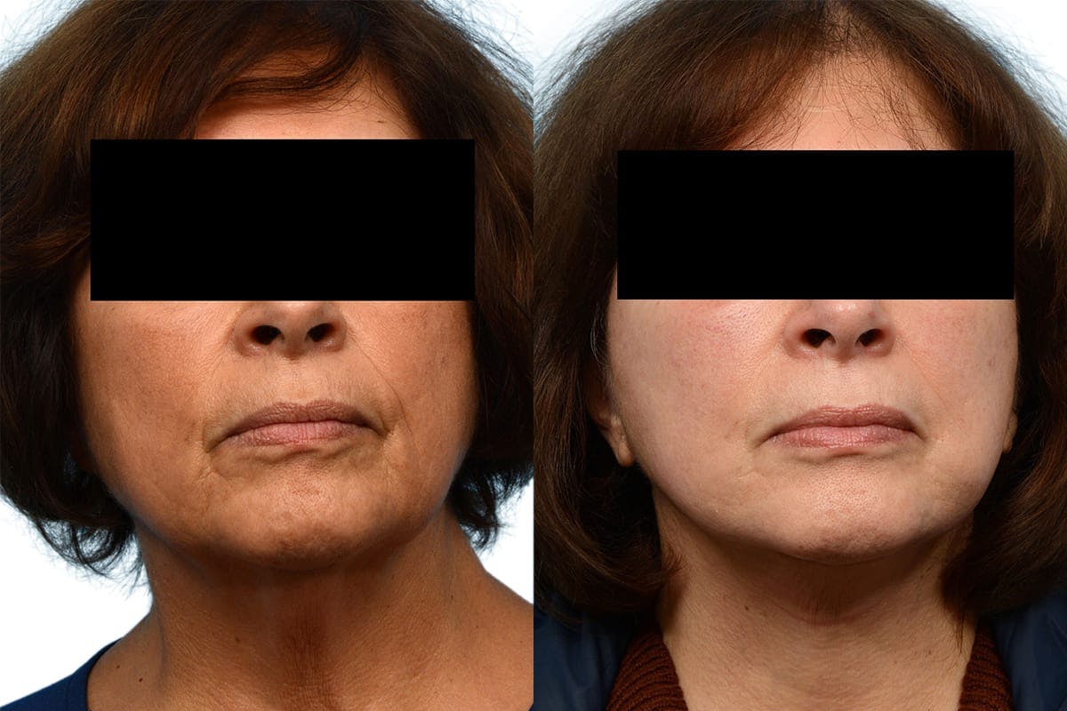 Facelift Before & After Gallery - Patient 372527 - Image 1