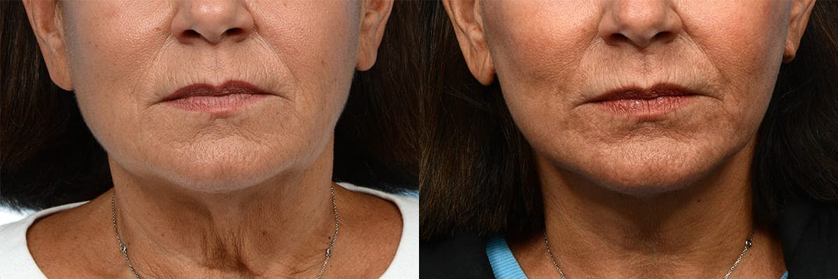 Facelift Before & After Gallery - Patient 156622 - Image 1