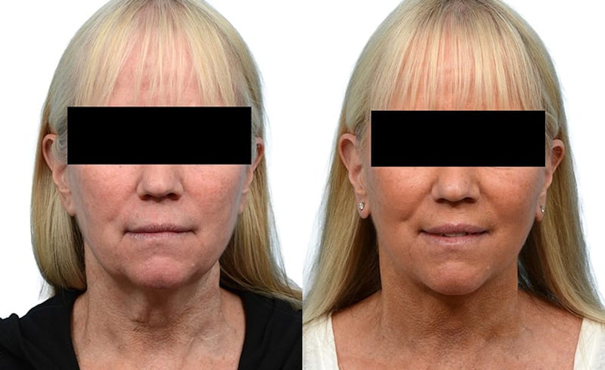 Facelift Before & After Gallery - Patient 284443 - Image 1