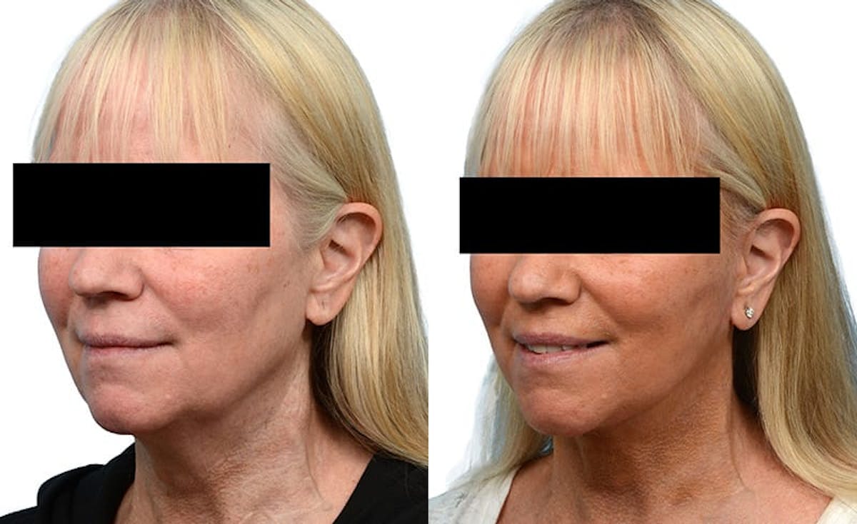 Facelift Before & After Gallery - Patient 284443 - Image 2