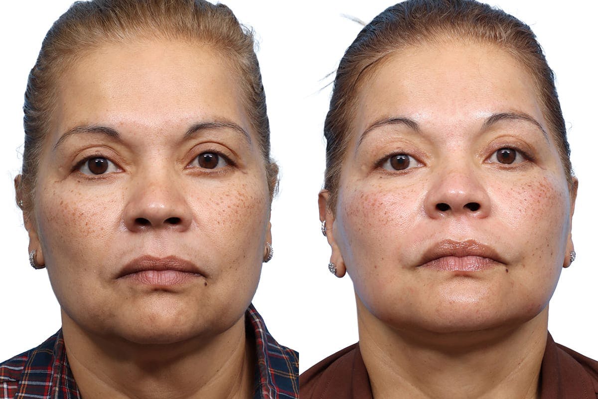 Facelift Before & After Gallery - Patient 211999 - Image 1