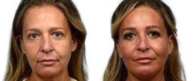 Facial Fat Transfer Before & After Gallery - Patient 120115 - Image 1