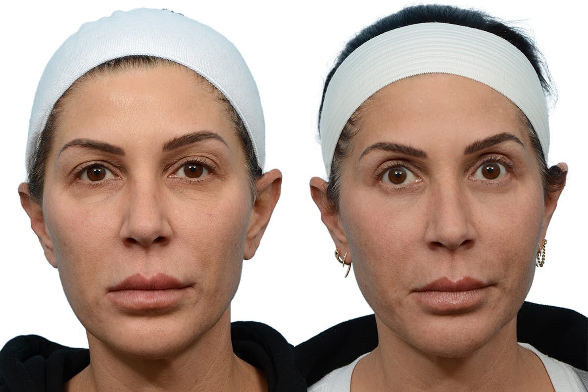 Facial Fat Transfer Before & After Gallery - Patient 168431 - Image 1