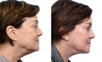 Facial Fat Transfer Before & After Gallery - Patient 334925 - Image 1