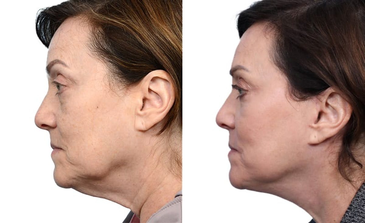 Facial Fat Transfer Before & After Gallery - Patient 334925 - Image 2