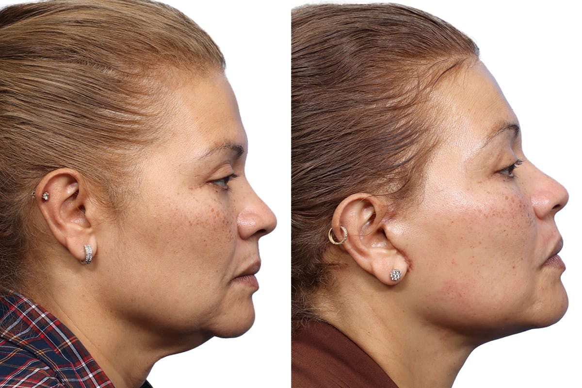 Facial Fat Transfer Before & After Gallery - Patient 342222 - Image 2