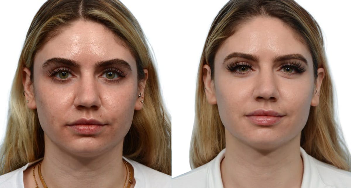 Morpheus8® Before & After Gallery - Patient 373257 - Image 1