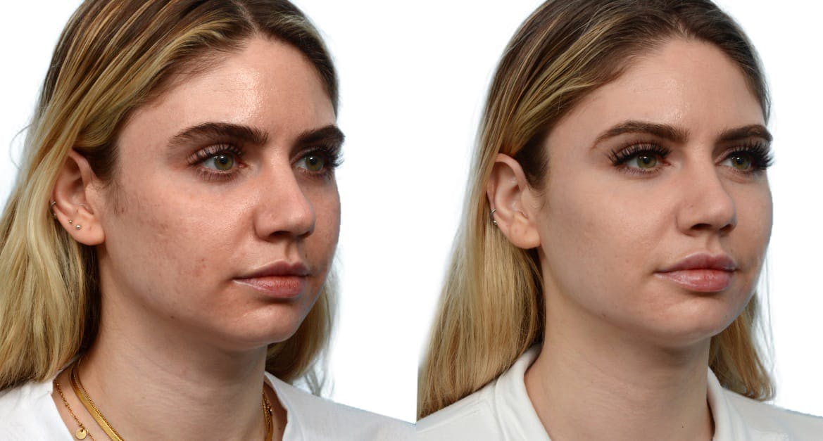 Morpheus8® Before & After Gallery - Patient 373257 - Image 2
