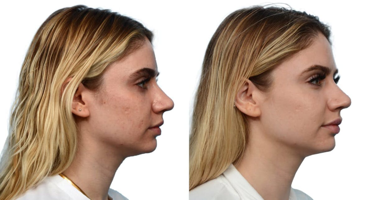 Morpheus8® Before & After Gallery - Patient 373257 - Image 3