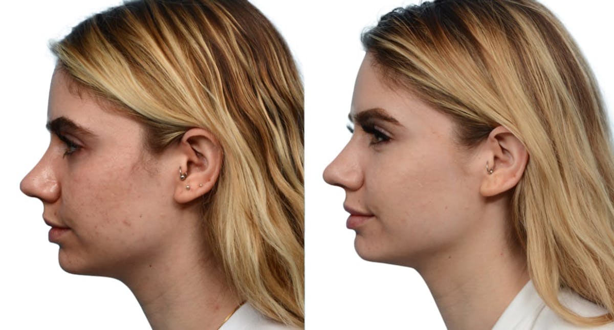 Morpheus8® Before & After Gallery - Patient 373257 - Image 5