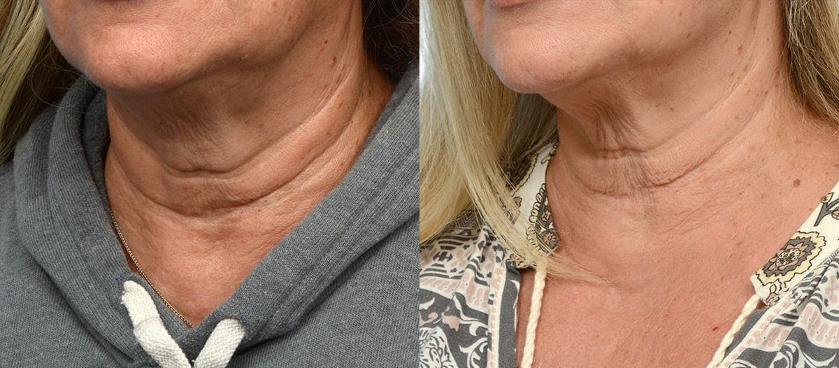 Morpheus8® Before & After Gallery - Patient 379308 - Image 1