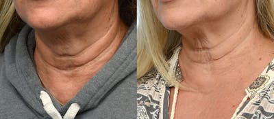 Morpheus8® Before & After Gallery - Patient 379308 - Image 1