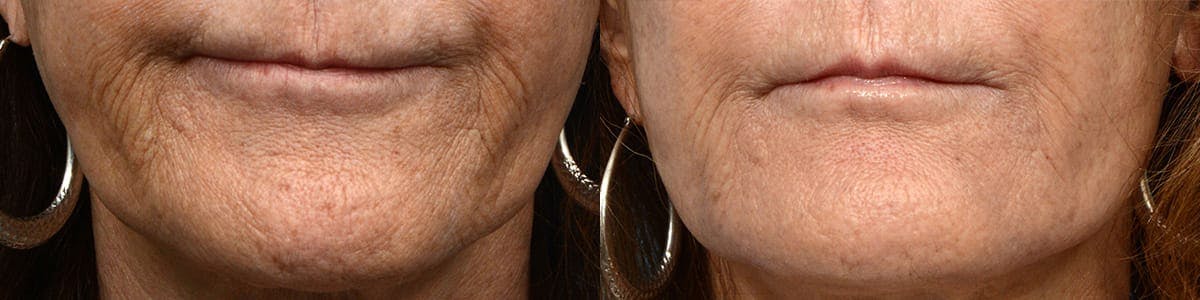 Morpheus8® Before & After Gallery - Patient 262067 - Image 1