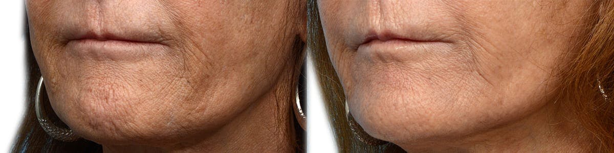 Morpheus8® Before & After Gallery - Patient 262067 - Image 2