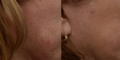 Picoway® Before & After Gallery - Patient 366282 - Image 1
