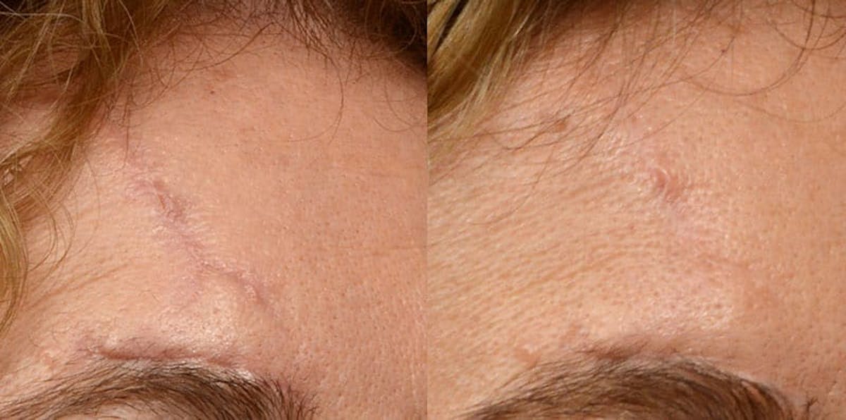 Picoway® Before & After Gallery - Patient 320748 - Image 1