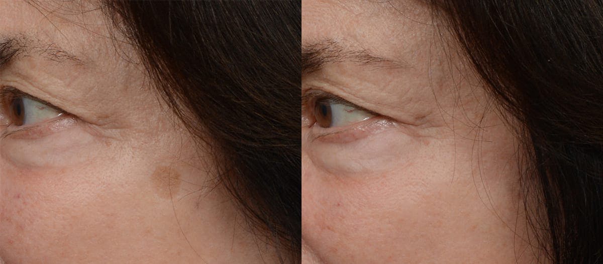 Picoway® Before & After Gallery - Patient 254422 - Image 1