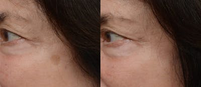 Picoway® Before & After Gallery - Patient 254422 - Image 1