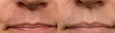 Picoway® Before & After Gallery - Patient 101472 - Image 1