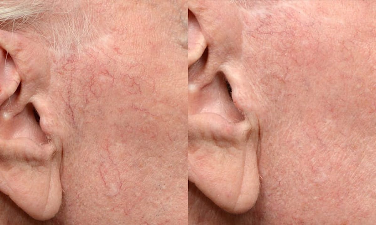 VBeam® Before & After Gallery - Patient 106835 - Image 1