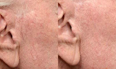 VBeam® Before & After Gallery - Patient 106835 - Image 1
