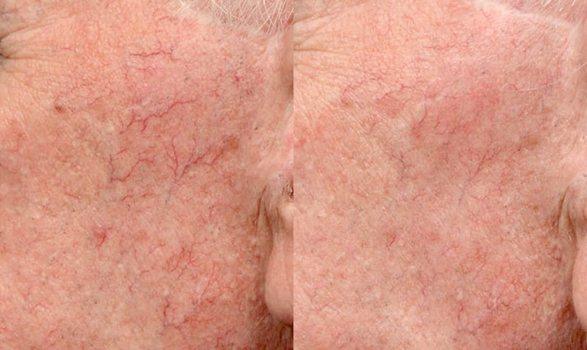 VBeam® Before & After Gallery - Patient 106835 - Image 2