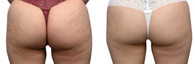 VBeam® Before & After Gallery - Patient 316299 - Image 1