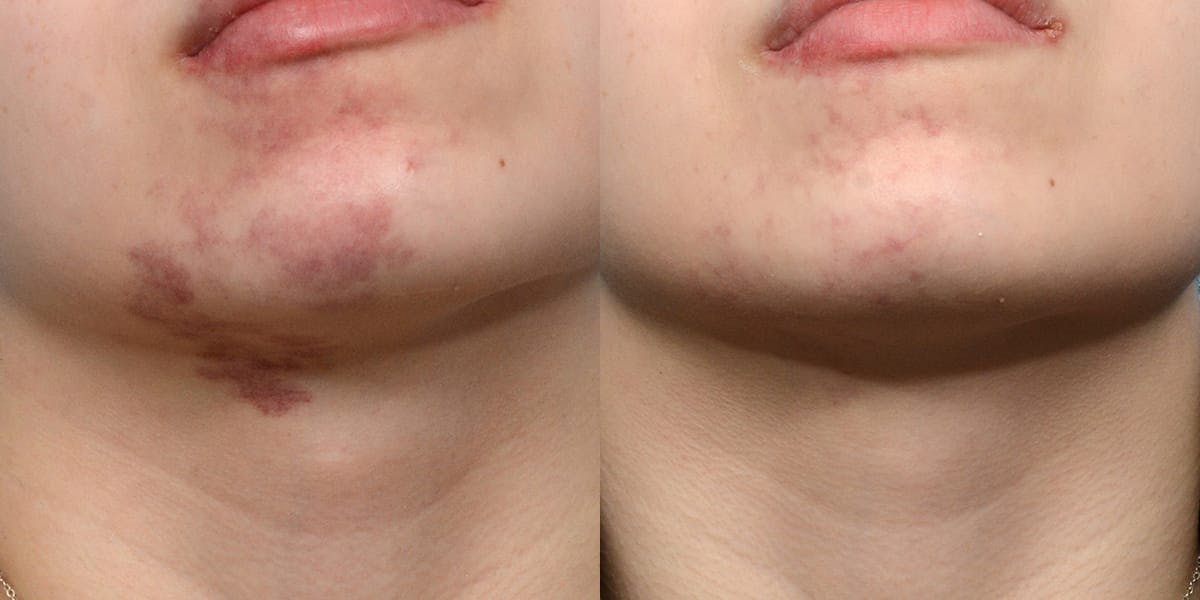 VBeam® Before & After Gallery - Patient 129550 - Image 1