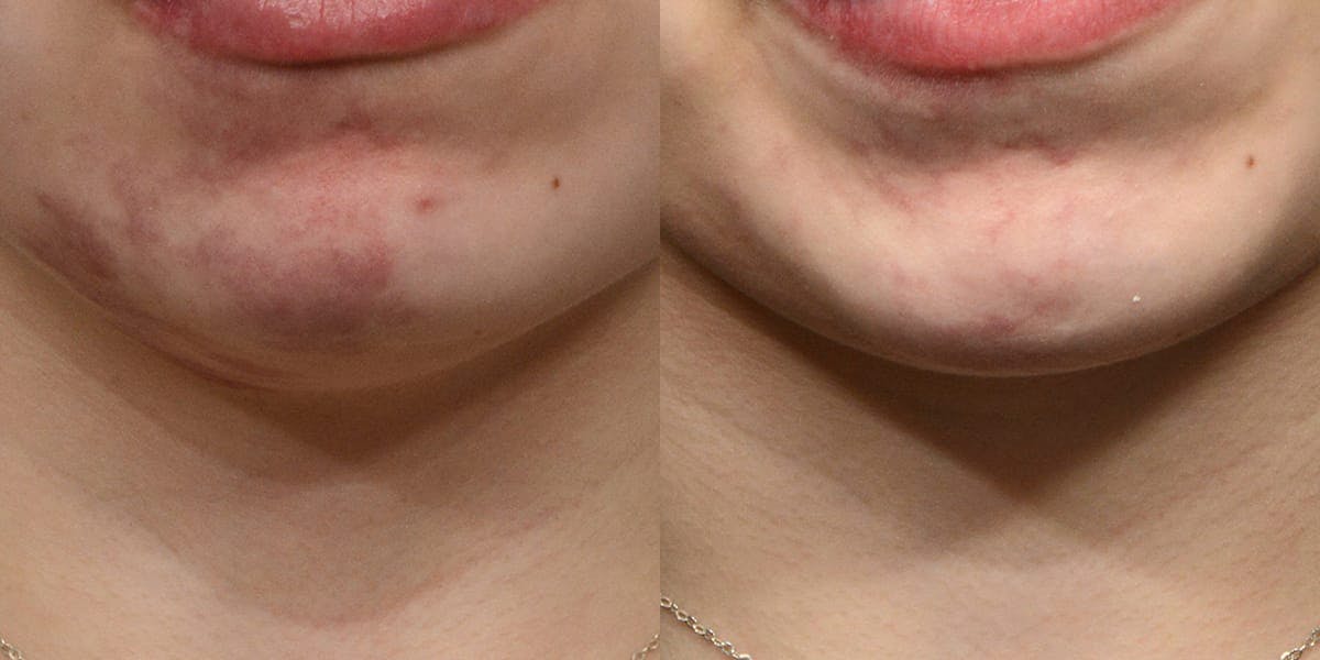 VBeam® Before & After Gallery - Patient 129550 - Image 2
