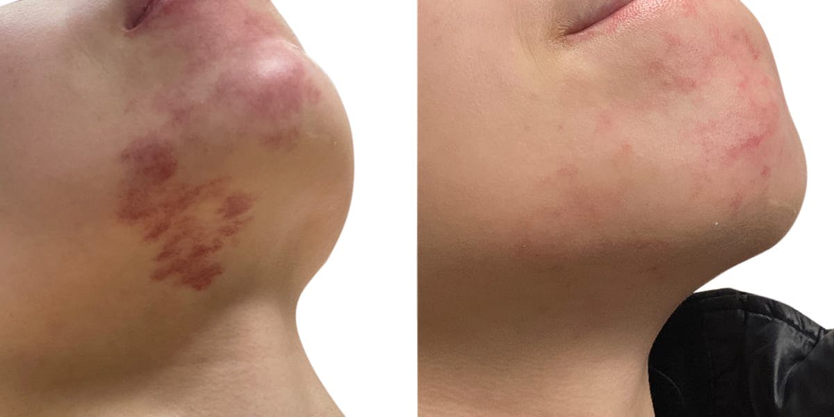 VBeam® Before & After Gallery - Patient 129550 - Image 3