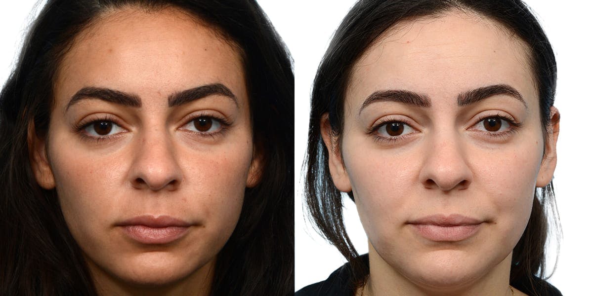 VBeam® Before & After Gallery - Patient 104547 - Image 1