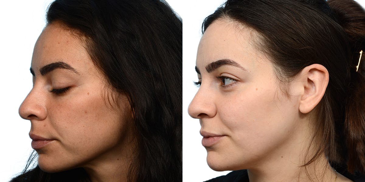VBeam® Before & After Gallery - Patient 104547 - Image 2
